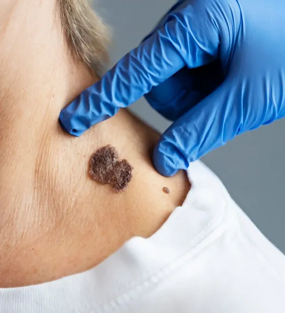 mole-removal.webp