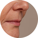 nasolabial-folds.png
